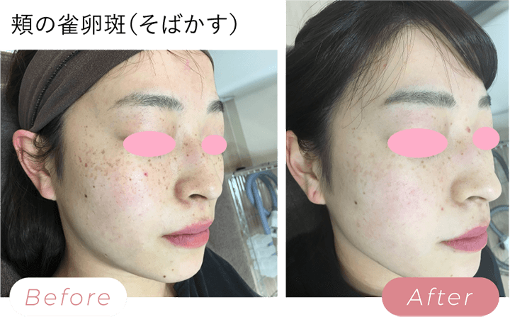そばかす治療に効果的なシルキーフォト