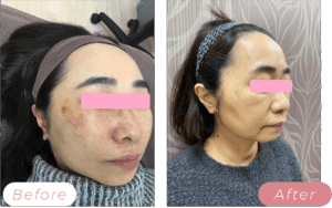 ピコトーニングビフォーアフター