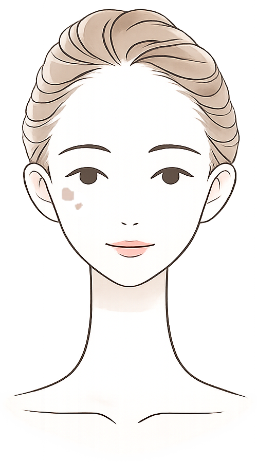 一般的なシミ(加齢性色素斑)