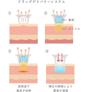 ルミンザ（ニードルRF）の3つの特徴