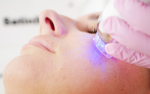 ルミンザ（ニードルRF）