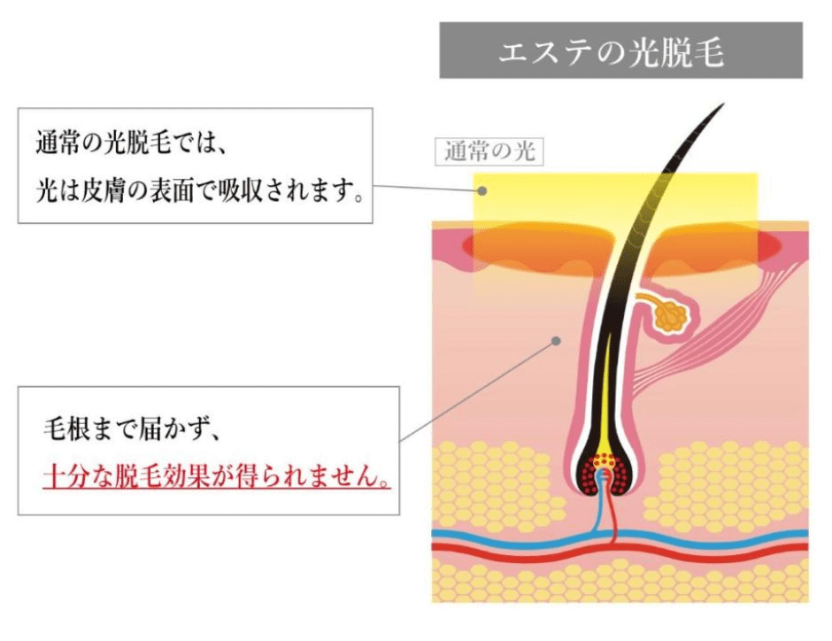 エステ脱毛イメージ