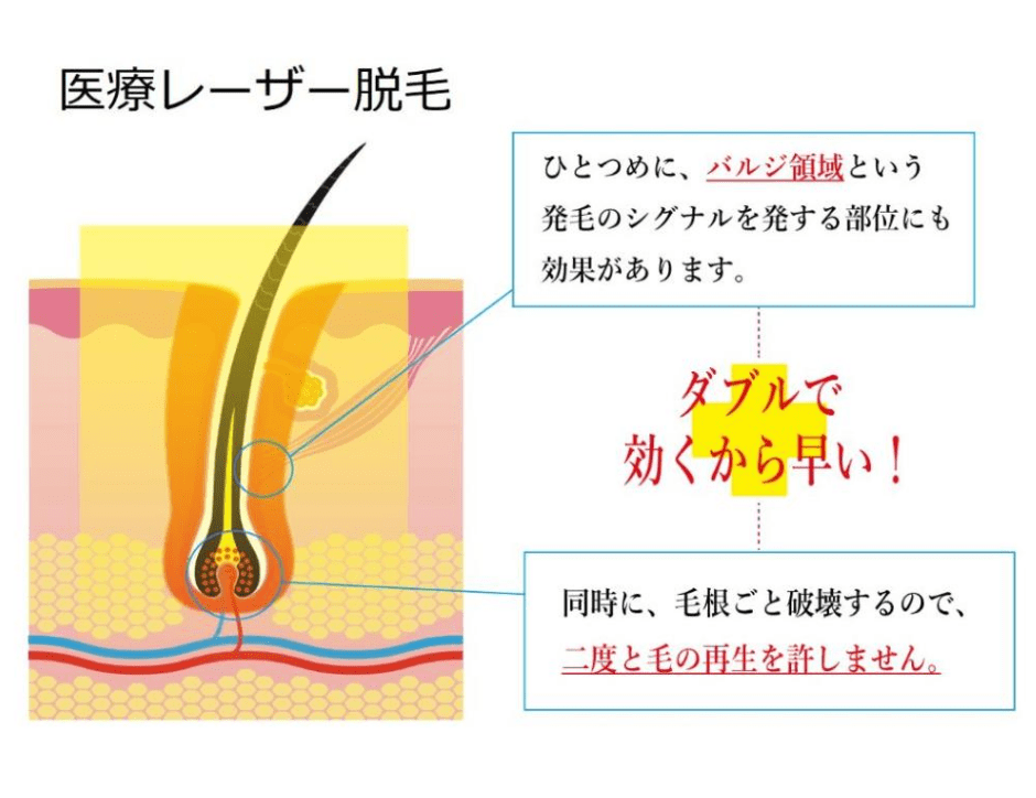 医療脱毛イメージ