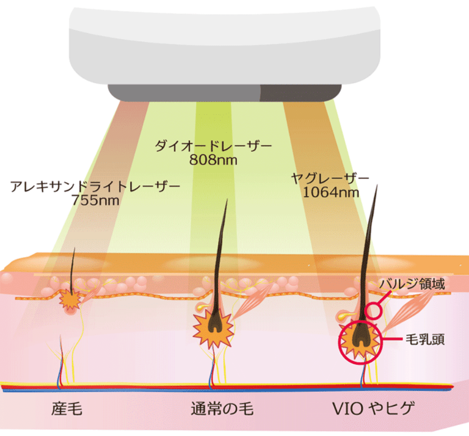 医療レーザーの仕組み