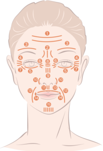 表情シワボトックスの施術可能箇所